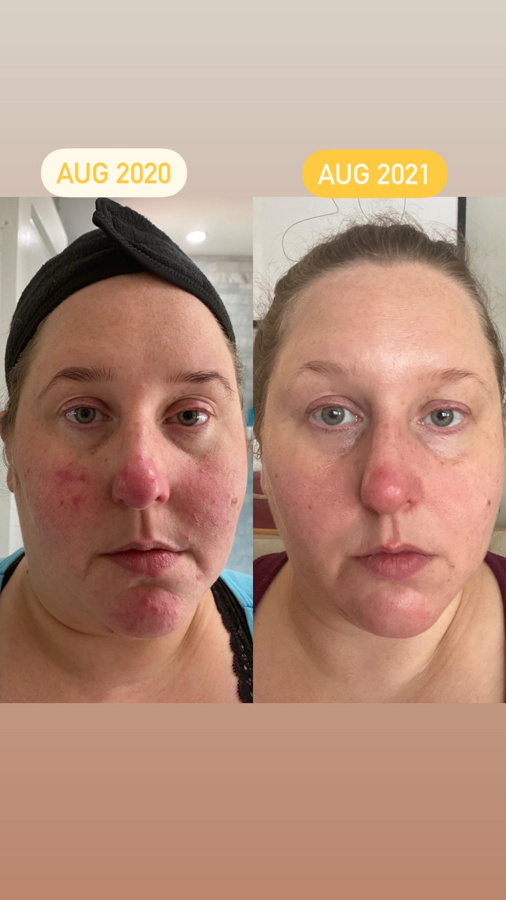 Picture of: B&A]  month skin healing action (routine in comments) : r