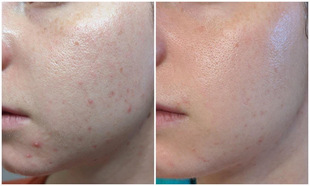 Picture of: B&A] Two months of actually taking my skincare routine seriously
