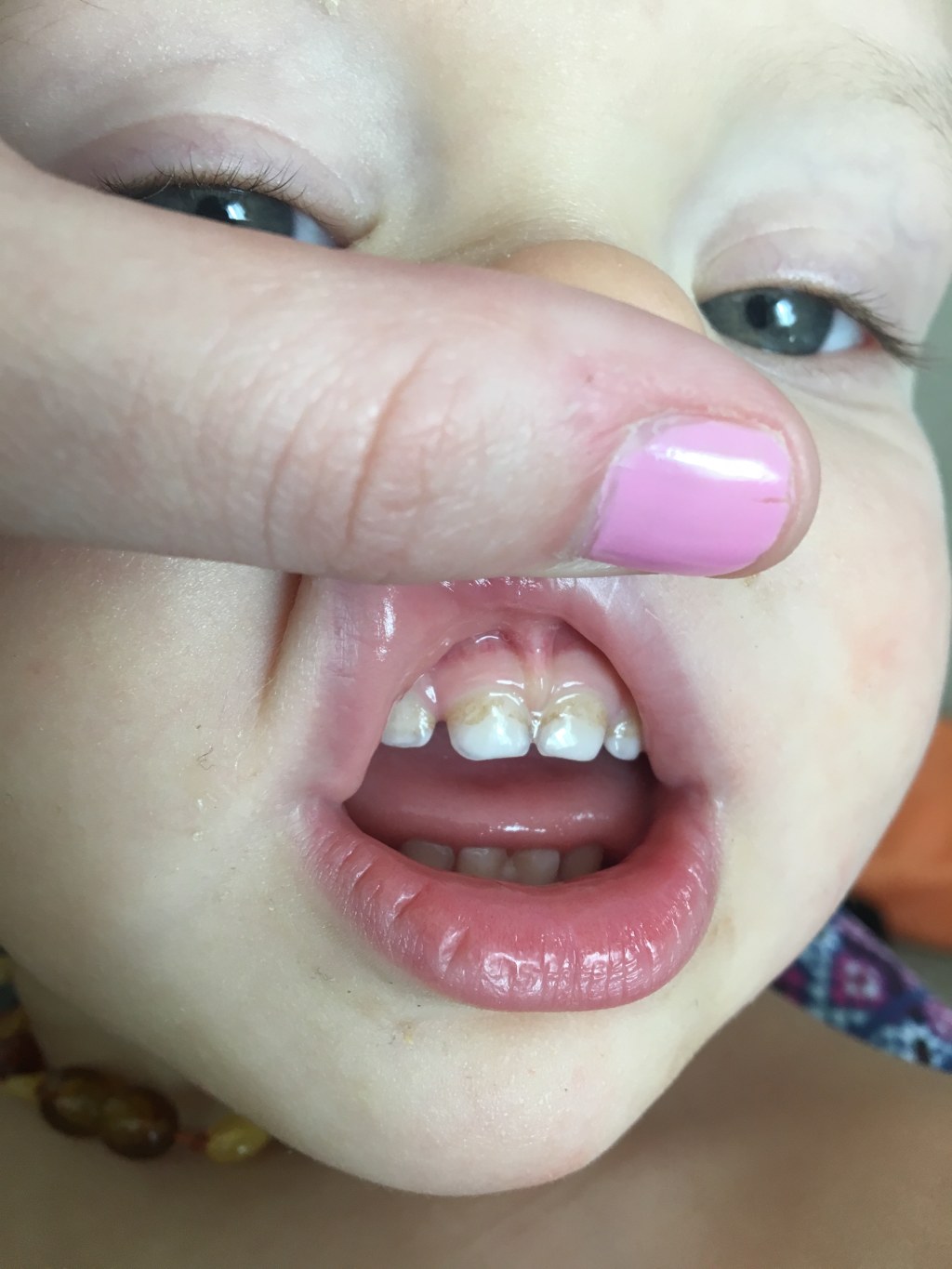 Picture of: Iron Supplement causing teeth discoloration?? – August  Babies