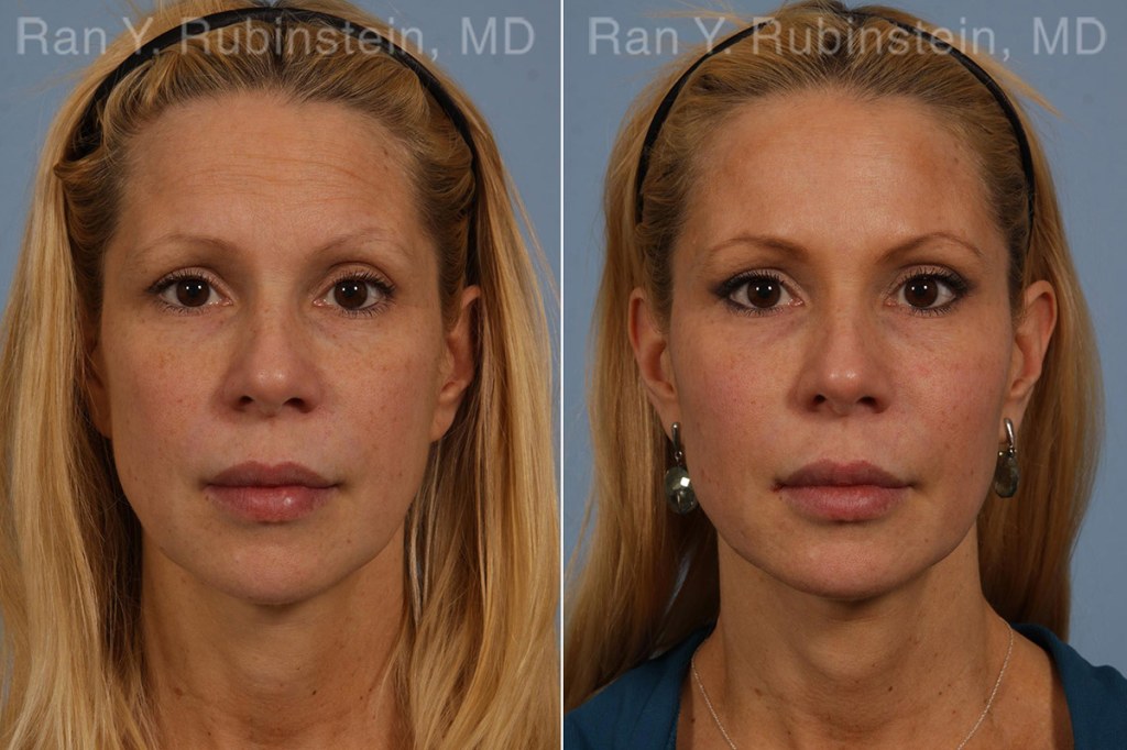 Picture of: Liquid Facelift in Hudson Valley, NY