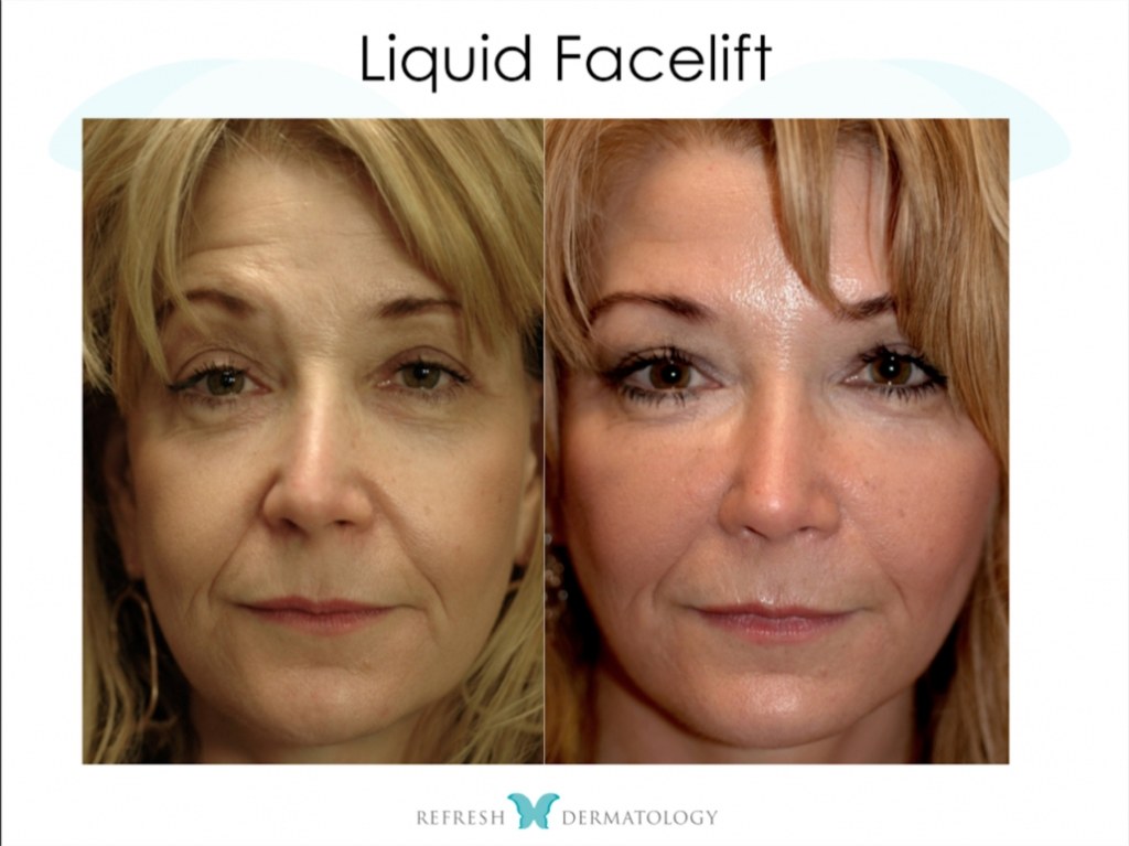 Picture of: Liquid Facelifts, Houston, TX  Refresh Dermatology