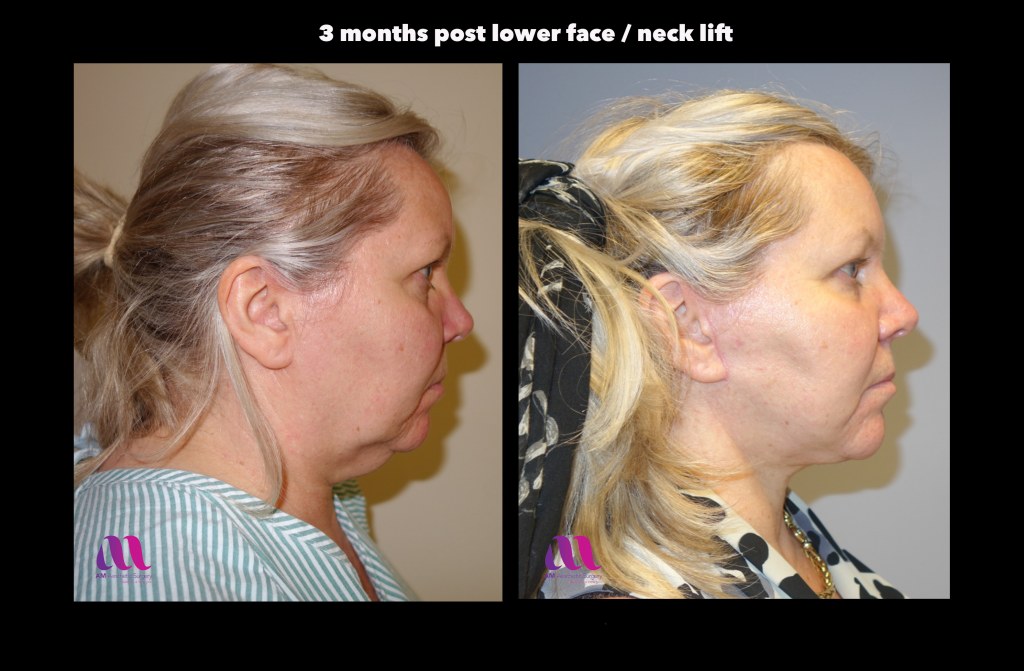 Picture of: Lower face / neck lift – A M Aesthetic Surgery