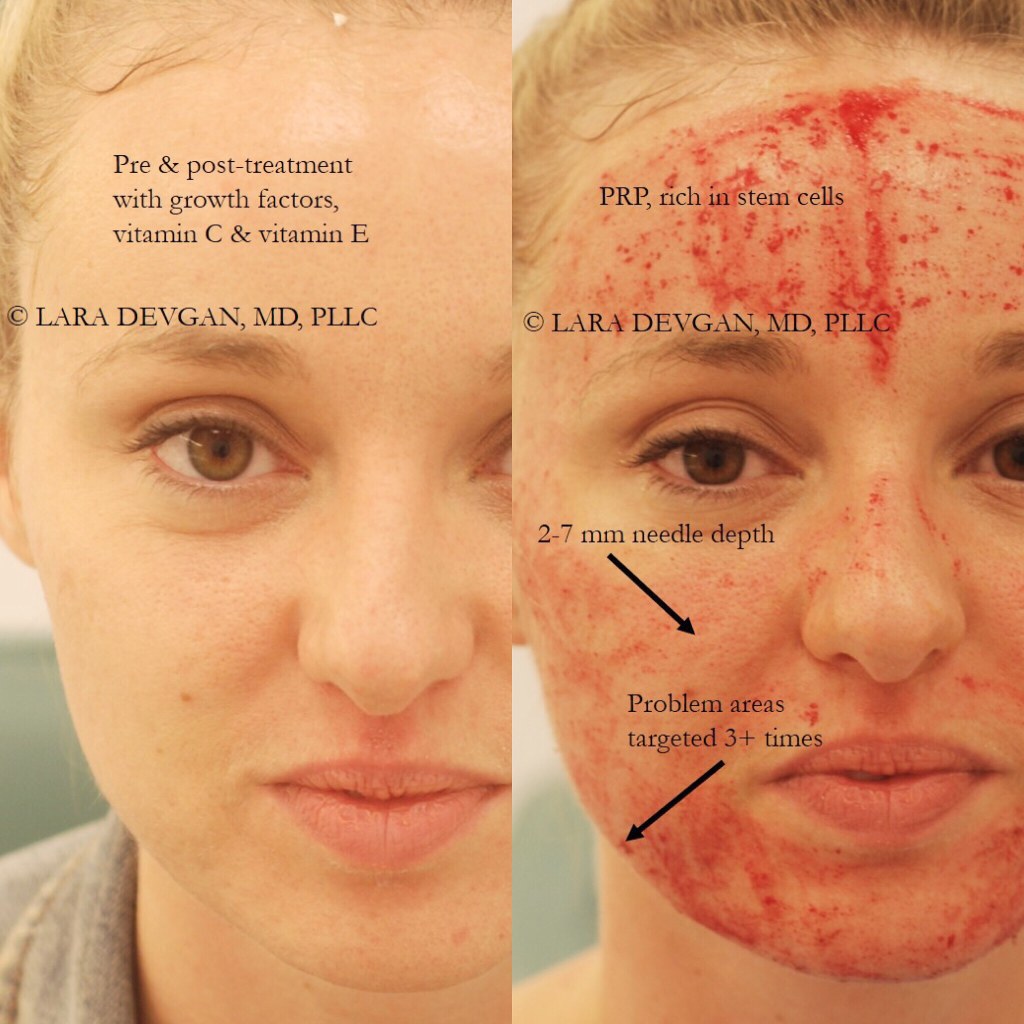 Picture of: Microneedling for Glowing Skin — Lara Devgan, MD, MPH, FACS
