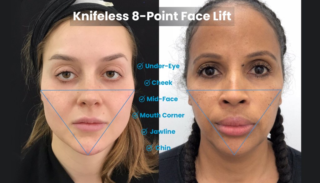Picture of: Point Face Lift — The Needle Taking Years Off Your Face!
